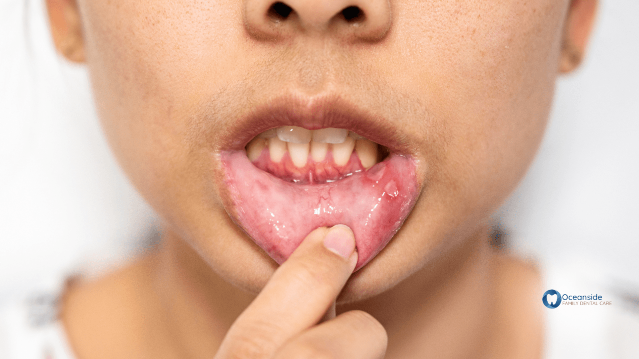 My child has canker sores! How can I help?